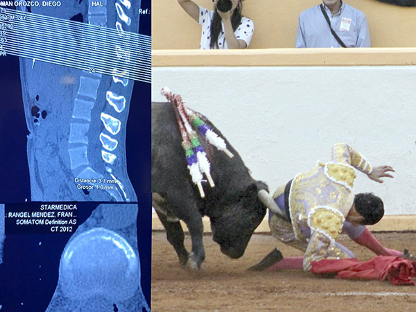 Diego permanecer� un mes en reposo