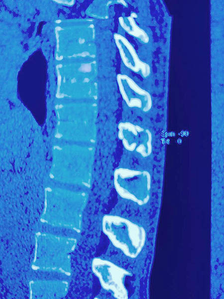 Vista lateral de la lesi�n