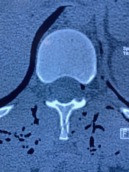 Da�ada la v�rtebra T12