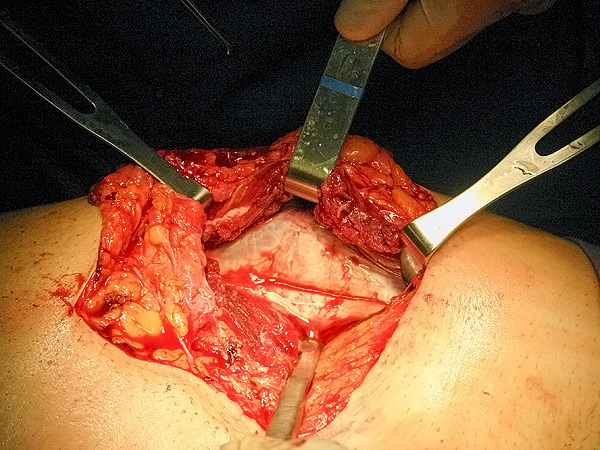 Profunda lesi�n muscular