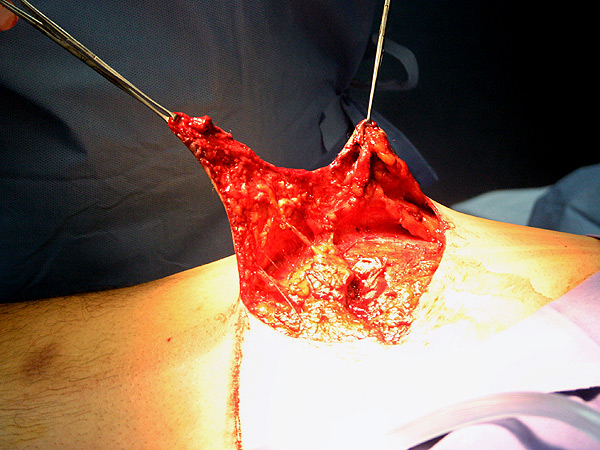 Correci�n del orificio con colgajo