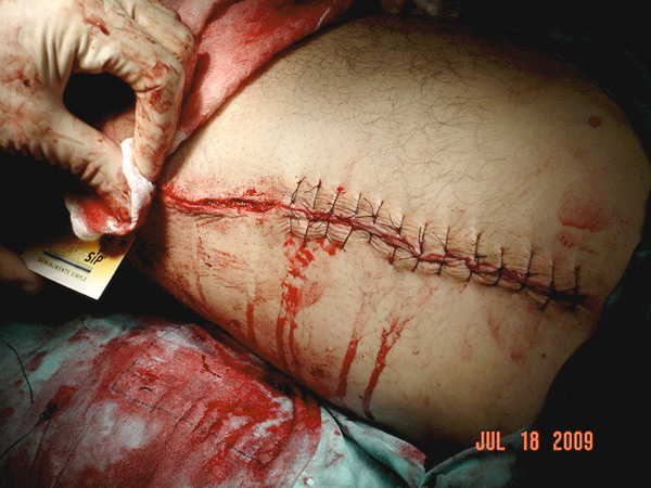 Los puntos para cerrar la herida