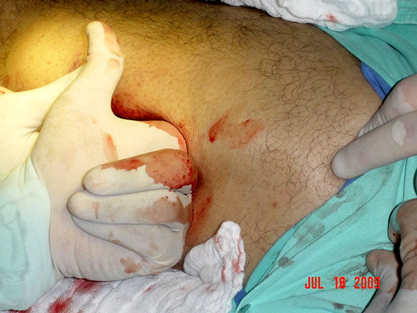 La profundidad de la herida