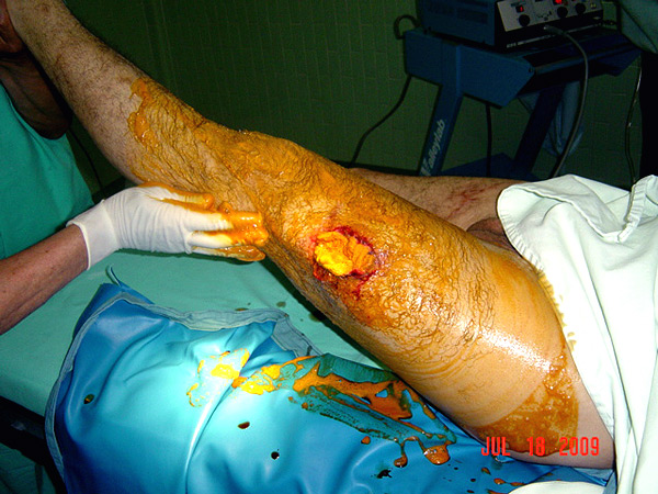 Antes de la operaci�n